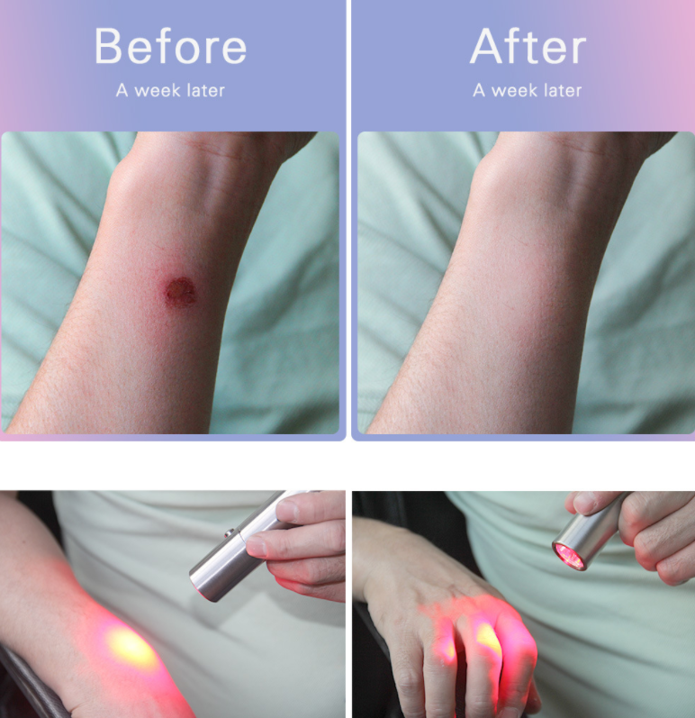 Portable Infrared Red Light Therapy Torch